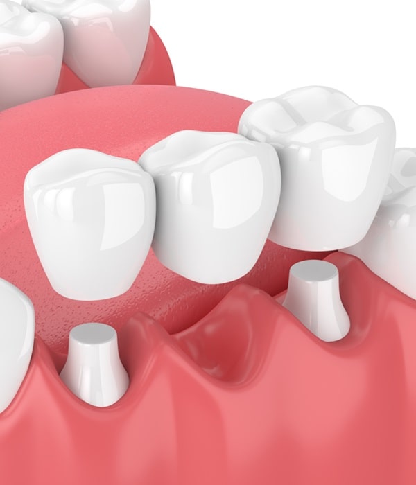 dental-bridge-wesbrook-village-dental-centre