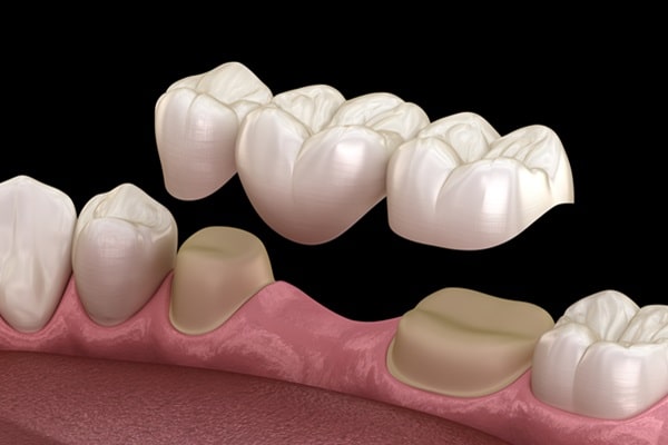 dental-bridges-wesbrook-village-dental