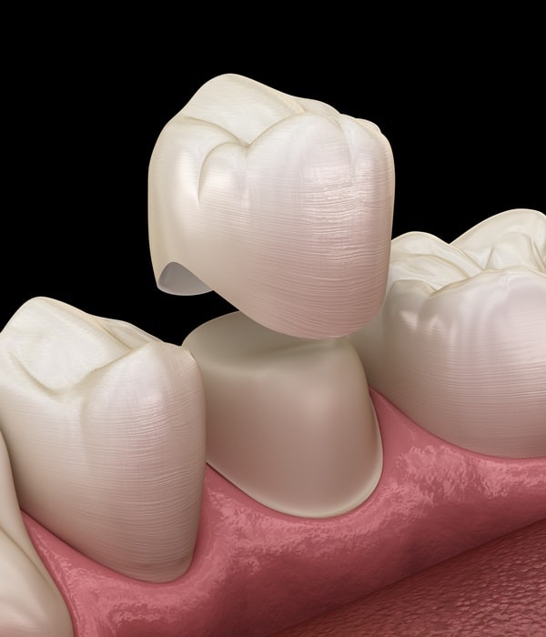 dental-crowns-wesbrook-village-dental-centre