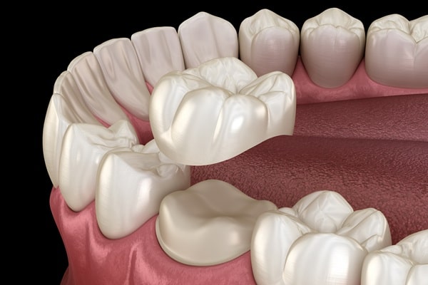 dental-crowns-wesbrook-village-dental