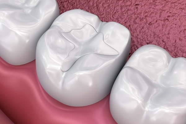 dental-fillings-wesbrook-village-dental