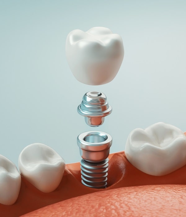 dental-implants-wesbrook-village-dental-centre
