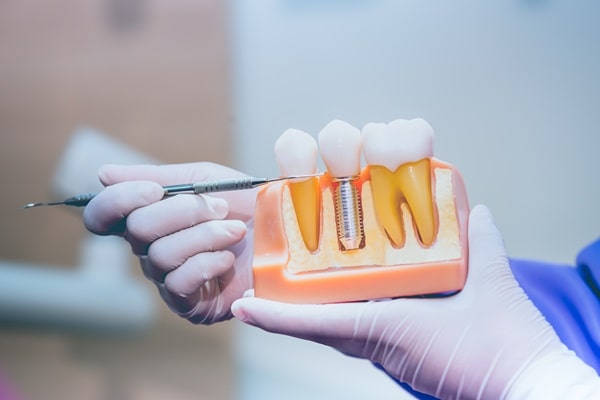 dental-implants-wesbrook-village-dental