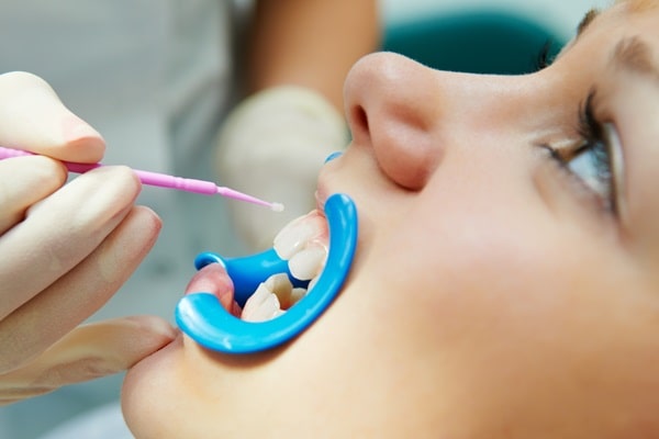 dental-sealants-wesbrook-village-dental