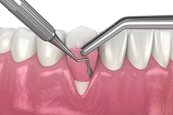 gum-grafting-wesbrook-village-dental