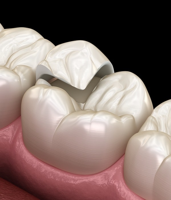 inlays-and-onlays-wesbrook-village-dental-centre