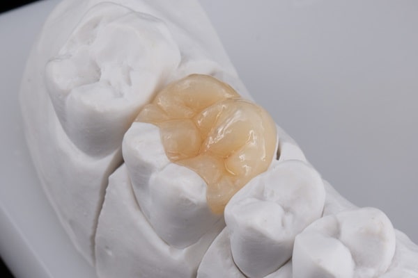 inlays-and-onlays-wesbrook-village-dental