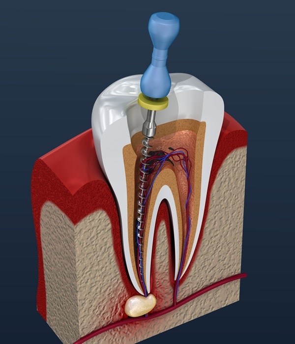 root-canals-wesbrook-village-dental-centre