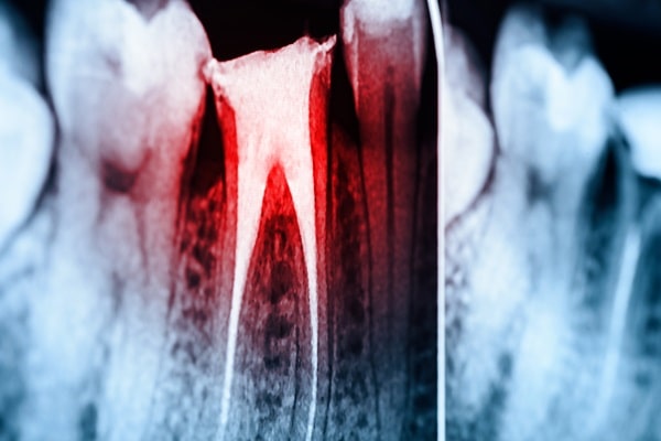 root-canals-wesbrook-village-dental