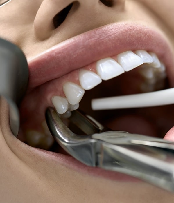 teeth-extractions-wesbrook-village-dental-centre