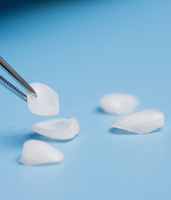 veneers-wesbrook-village-dental-centre
