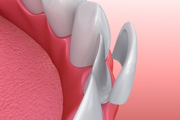 veneers-wesbrook-village-dental